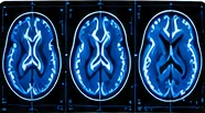 AI-Based MRI Image Processing illustration